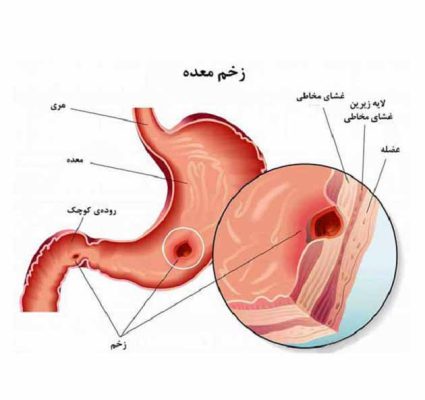 زخم معده